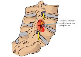 通常の除圧術に椎間孔拡大術を追加した３手術例についての検討